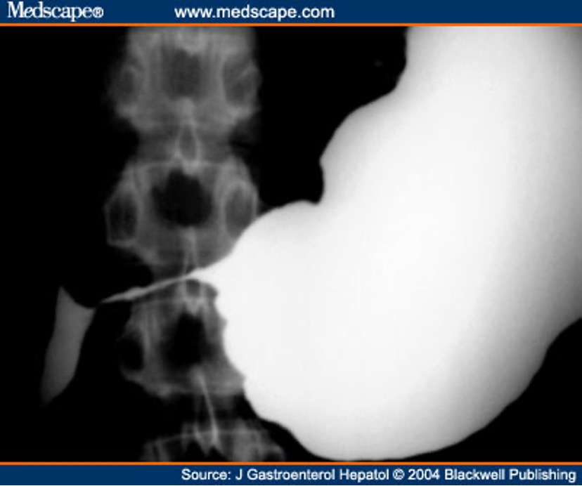 <p>can be caused by neoplasm, diabetes/gastroparesis, or narcotic addiction</p><p>enlarged stomach may be seen on plain films</p><p>UGI or EGD can be used</p>