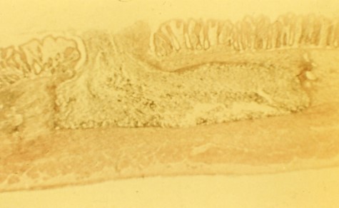 <p>Vector: contaminated water with cysts Cardinal Sign: Flask shaped ulcer Distribution: worldwise, most common in tropics and subtropics</p>