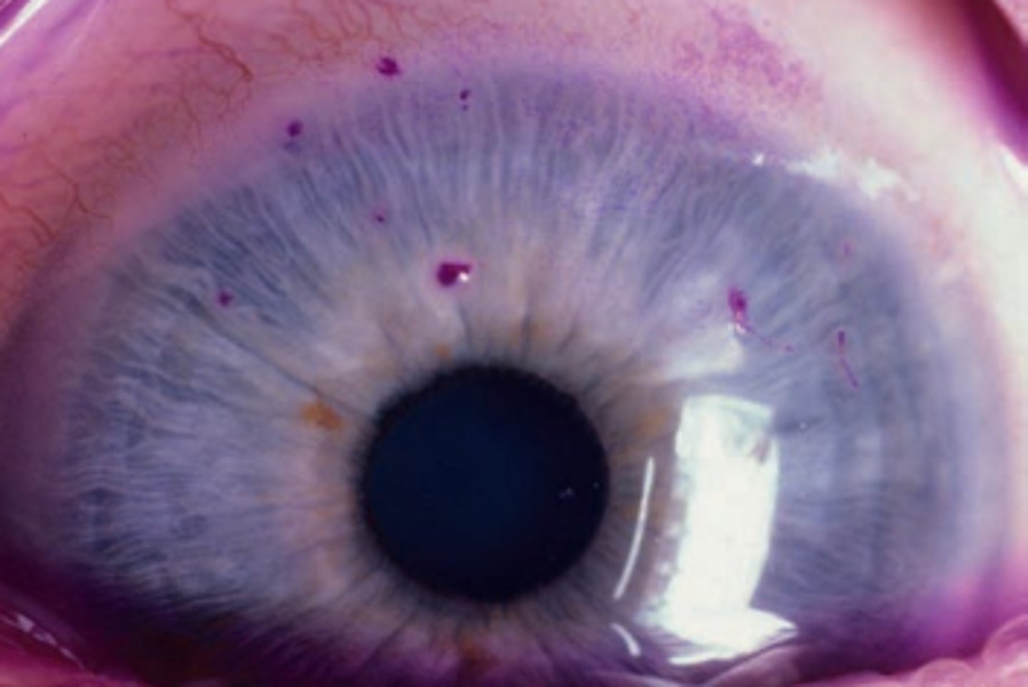 <p>condition where an area of loose epithelium acts as a focus for deposition of mucus and cellular debris filaments involving aqueous deficiency and increased mucin production. Is more common in women and incidence increases with age. Is caused by aqueous deficient DES, excessive CL wear, etc. Symptoms include discomfort, photophobia, etc. Will stain well with Rose Bengal. Treatment involves addressing the underlying condition, manually removing filaments, mucolytic agents, topical NSAIDs</p>