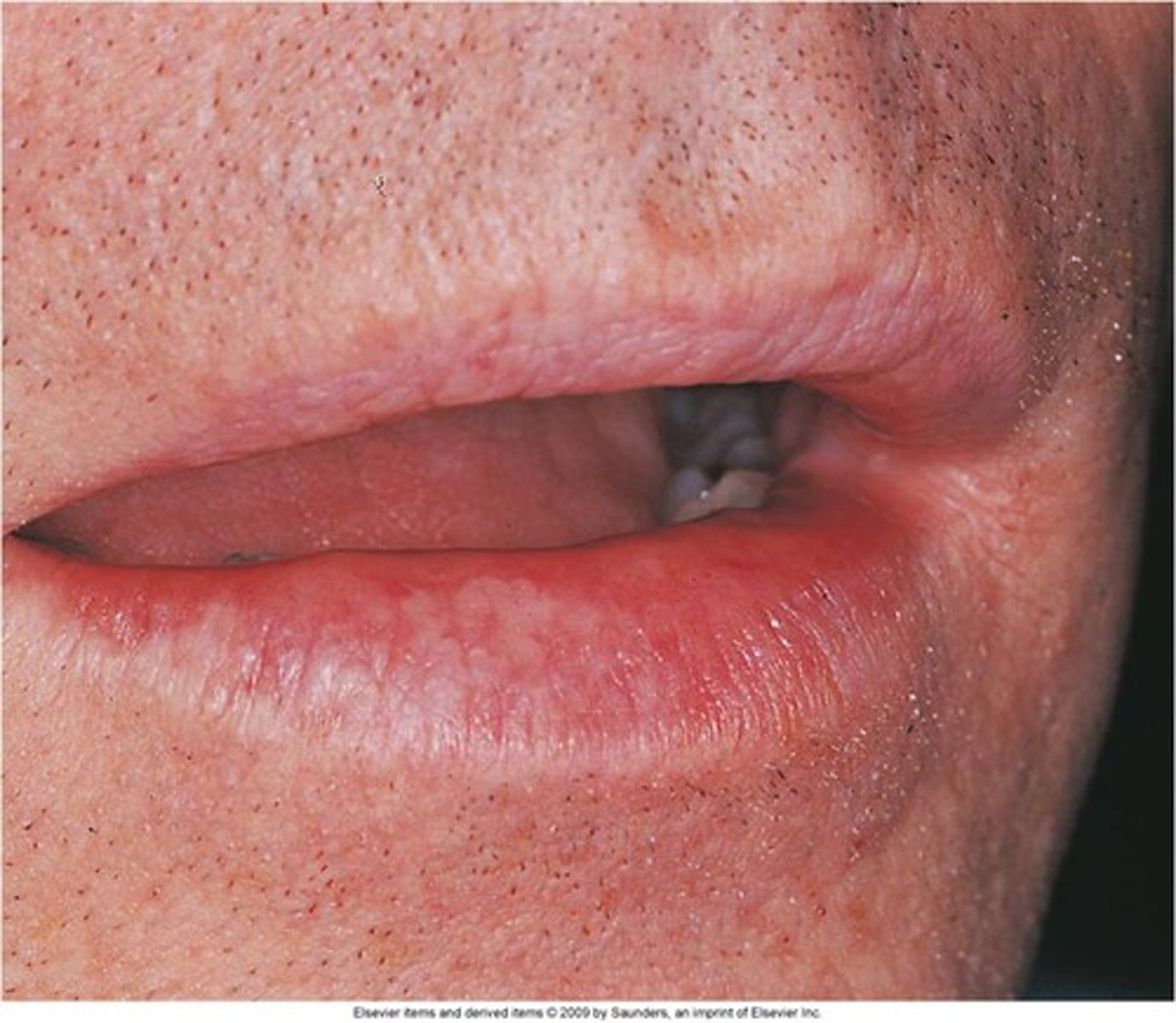 <p>Image of lips with slight loss of vermillion border, a scar, and normal looking otherwise</p><p>what was wrong with the patient:</p><p>normal irregularities,</p><p>angular chelititis,</p><p>solar something</p>