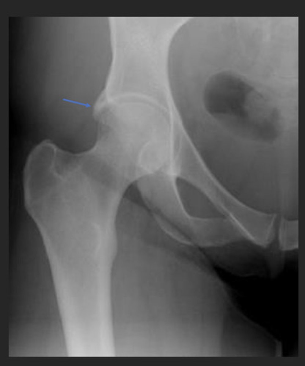 <p>overgrowth of the acetabular rim</p>