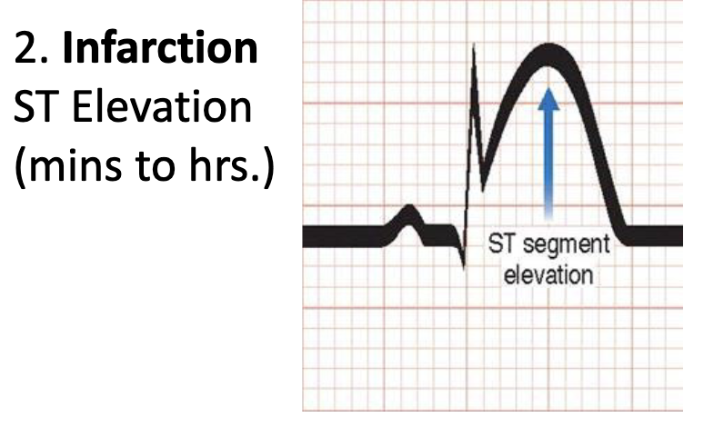 <p>Infarction ST Elevation (mins to hrs.)</p>