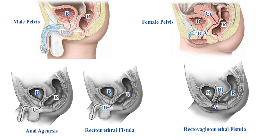 <p>-variety of congenital abnormalities that are a result of an <strong>incomplete subdivision </strong>of hindgut</p><p>-fistula = an abnormal connection between two hollow spaces</p>