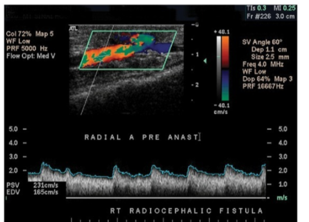 <p>In a fistula, the arterial inflow will be, the diastolic flow will be___, and the PSV will be ___.</p>