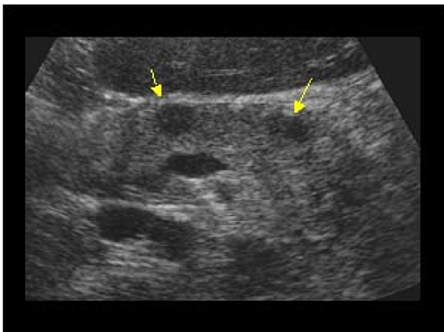 <p>-Difficult to see with ultrasound</p><p>-Multiple lesions in pancreas or in duodenum</p>