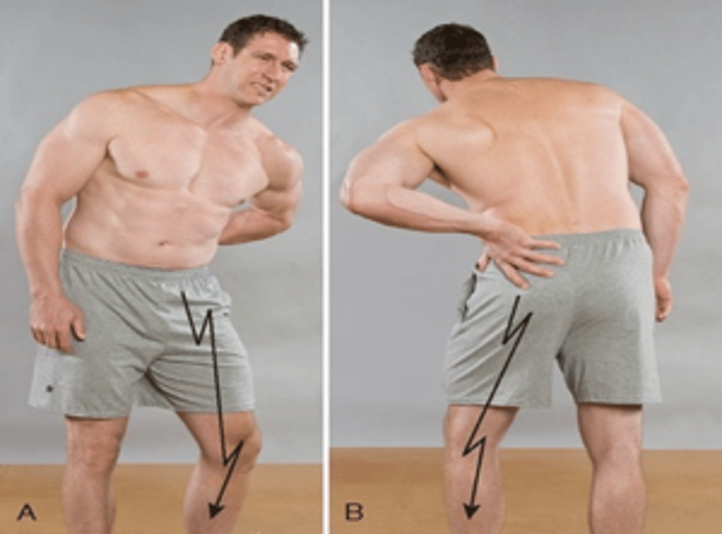 <p>When the disc protrudes medial to the nerve root, the patient assumes an antalgic lean into the side of the disc lesion or pain</p>
