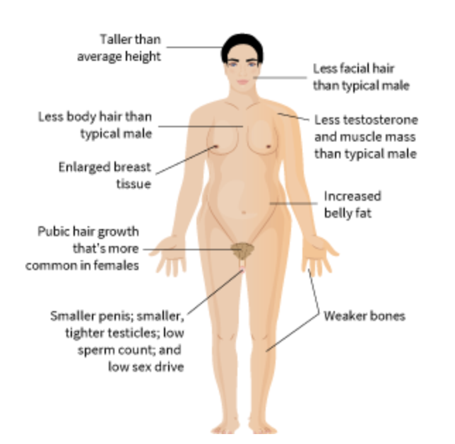 <table style="min-width: 25px;"><colgroup><col style="min-width: 25px;"></colgroup><tbody><tr><td colspan="1" rowspan="1" style="box-sizing: inherit; border: 1px solid grey; max-width: 800px; padding-left: 5px; padding-right: 5px;"><p><br>1 in 1,000 births;&nbsp;<span>having XXY genes. Tend to <u>have smaller penises and testicles, lower testosterone levels, sparse body hair, and gynecomastia (breast development).&nbsp;</u>Lower sperm count, decreased fertility, and delayed or absent puberty</span></p></td></tr></tbody></table><p></p>