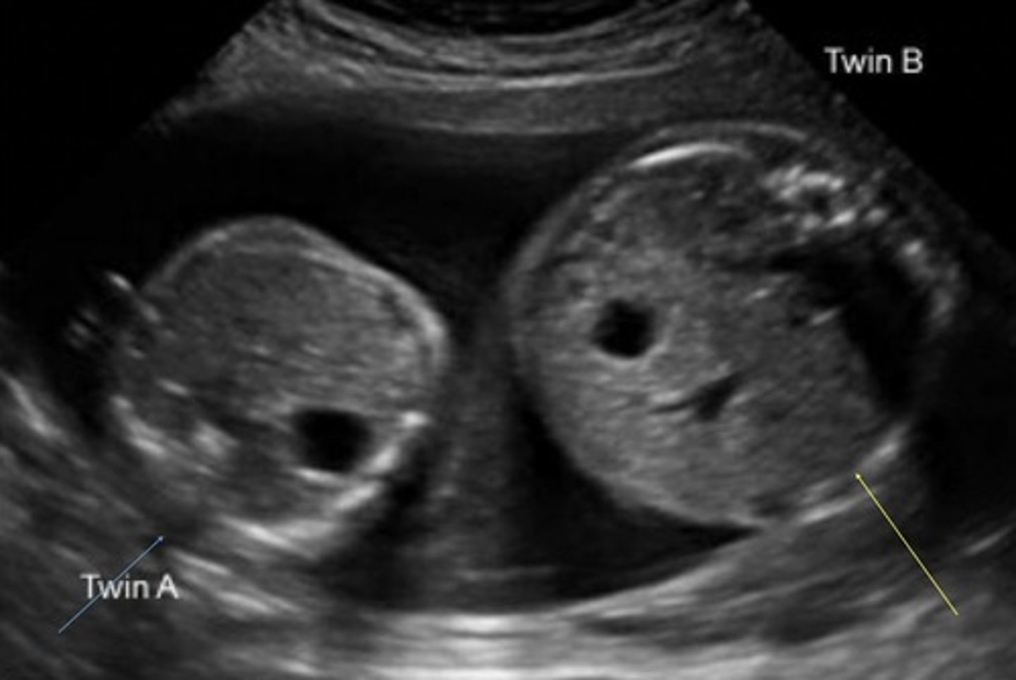 <p>>20% overall difference between the twins</p><p>AC difference of 20mm</p><p>BPD difference of 6mm</p><p>Femur length difference of 5mm</p>