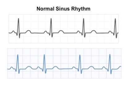 <p><span><span>Compared to the normal rhythm shown first, what is most likely happening in the second ECG?</span></span></p>