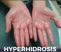 <p>what is hyperhidrosis?</p>