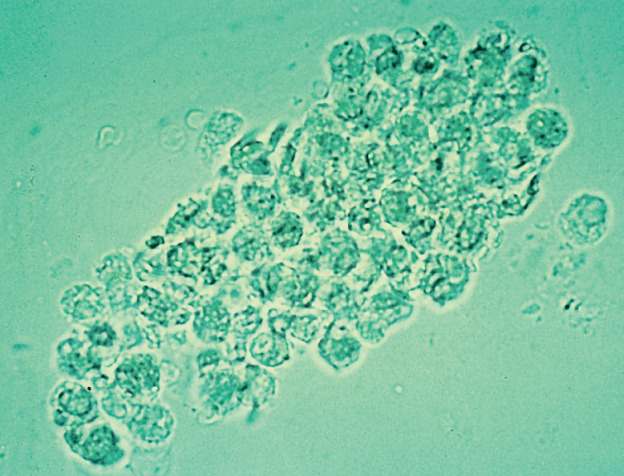 <p>Clump of WBC typically seen in lower UTI</p><ul><li><p>Not a true cast</p></li><li><p>Absence of cast matrix</p></li></ul><p></p>