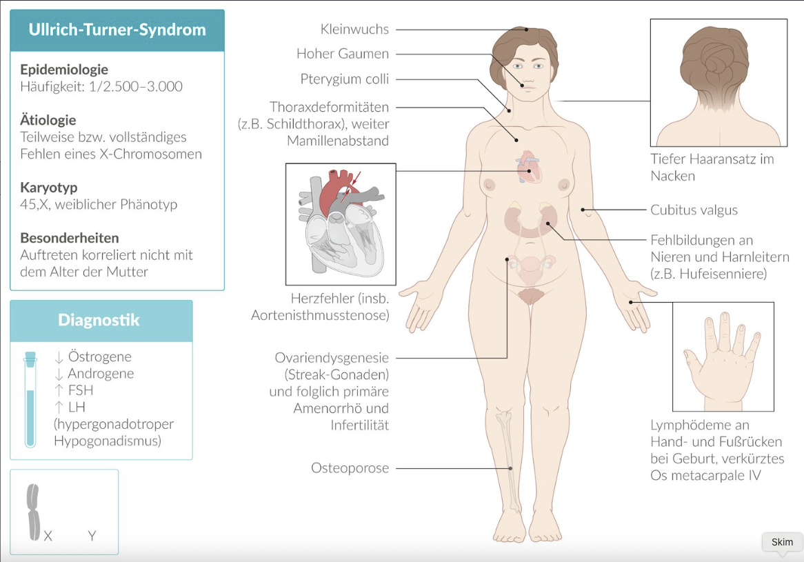<p>E. Ullrich–Turner syndrome (45,X)</p>