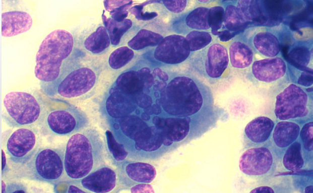 <p>Criteria of malignancy - Nuclear Features</p><p>Describe the cell - malignant or no? Why?</p>