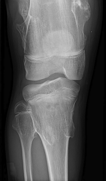 <p>14 y/o boy, knee pain after tripping and falling on wrestling mat</p><p>fixed, hard lesions palpated above and below the knee; cortices are contiguous with cortex of surrounding bone</p>