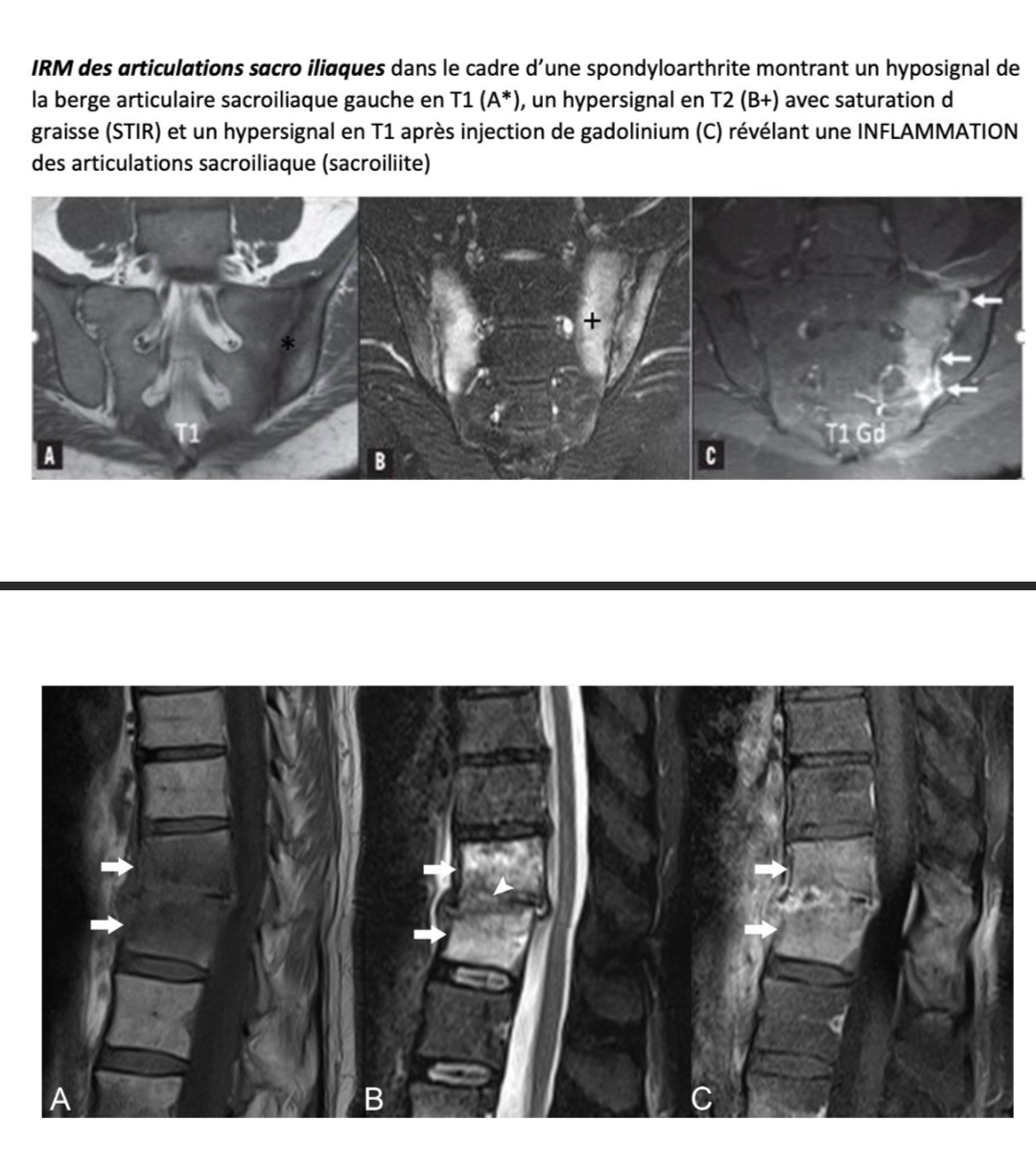 <ul><li><p>inflammation des articulations sacro-iliaques </p></li></ul><p></p>