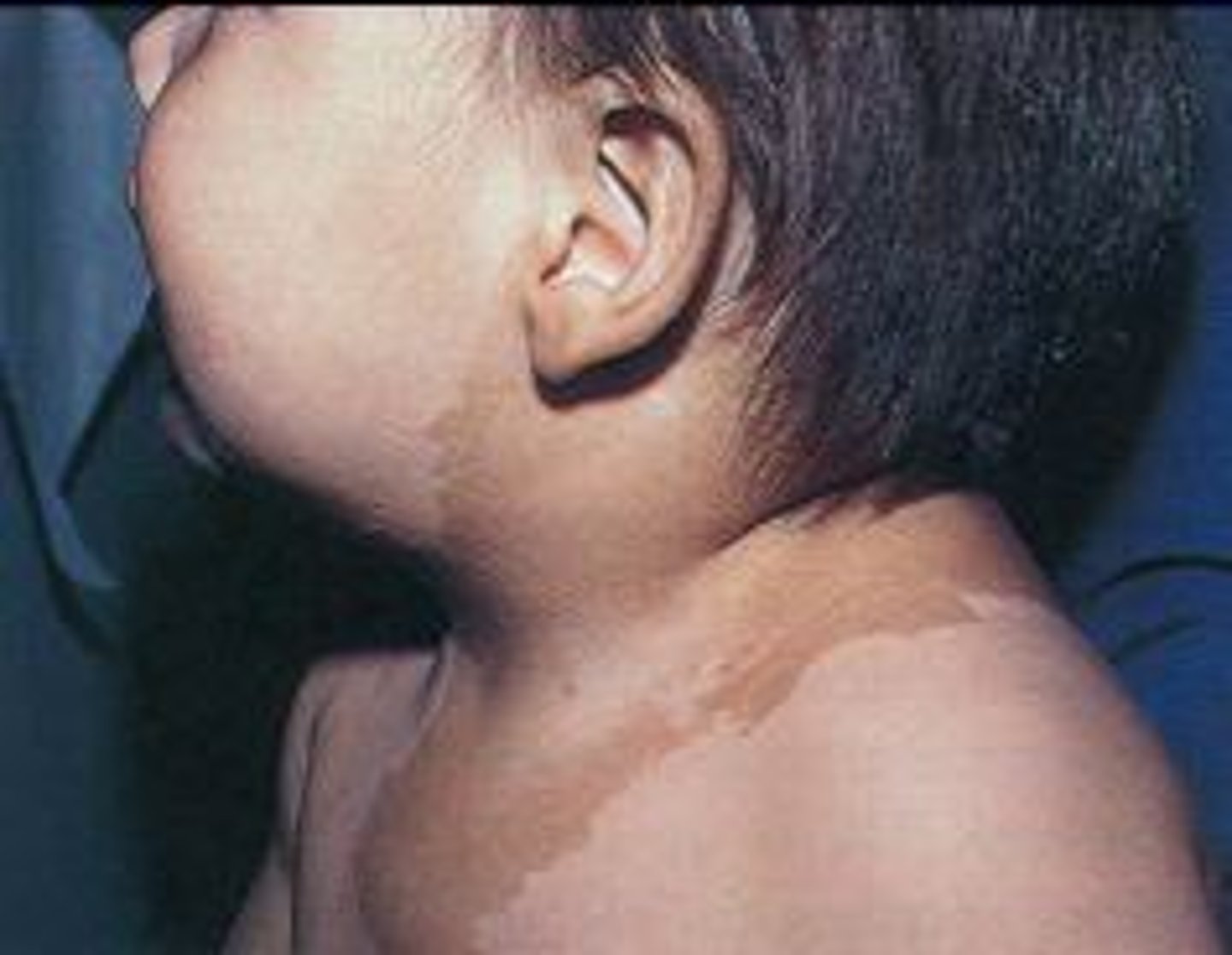 <p>-a well-defined, evenly pigmented brown macule or patch</p><p>-light to dark brown depending on pts skin pigment</p><p>-onset is usually evident in early childhood as solitary lesion</p><p>-a single lesion is present in 10-20% of US population, and 1% of healthy YA have up to 3 spots</p>