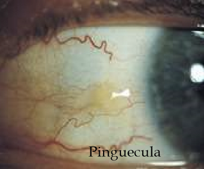 <p>A common, benign, yellowish or whitish growth on the bulbar conjunctiva and limbus</p>