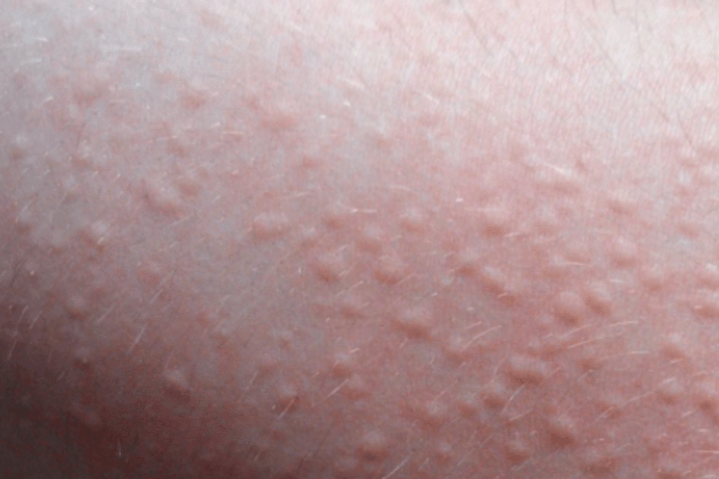 <p><strong>Cholinergic urticaria</strong>; clinical observation and provocation tests.</p>