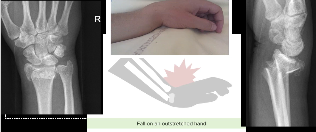 <p>Colles Fracture. Fracture of both the distal radius and ulna. This has an ulnar styloid avulsion fracture for the ulnar fracture on these images. FOOSH with extended hand.</p>