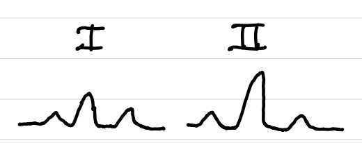 <ul><li><p>I positive, II positive → normal</p></li><li><p>I positive, II negative → left deviation</p></li><li><p>I negative, II positive → right deviation</p></li><li><p>I negative, II negative → extreme right deviation</p></li></ul><p></p>