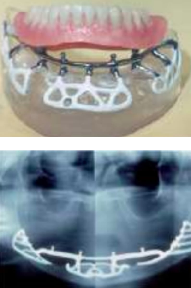 <p>ID the type of dental implant:</p>