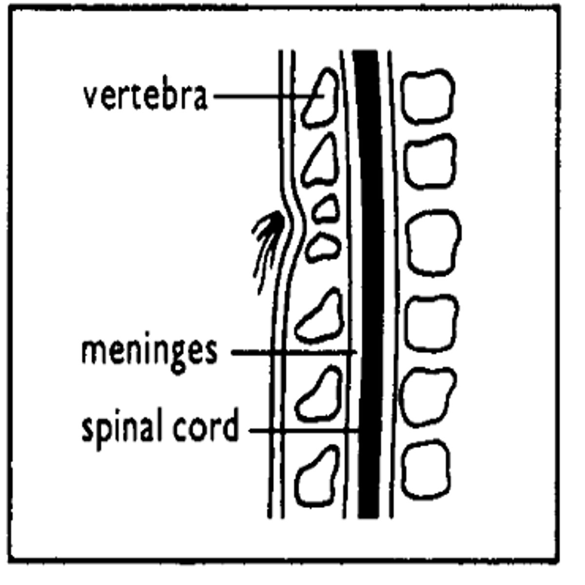 <p>- Mildest form, one or more vertebrae (usually L5 and S1) are not closed but no protrusion of spinal cord.</p><p>- Cutaneous stigmata at lesion level</p><p>- May be associated with cyst in spinal cord or tethered cord syndrome</p><p>- Often associated with anorectal and/or urogenital malformations, bowel, bladder, and sexual dysfunction.</p>