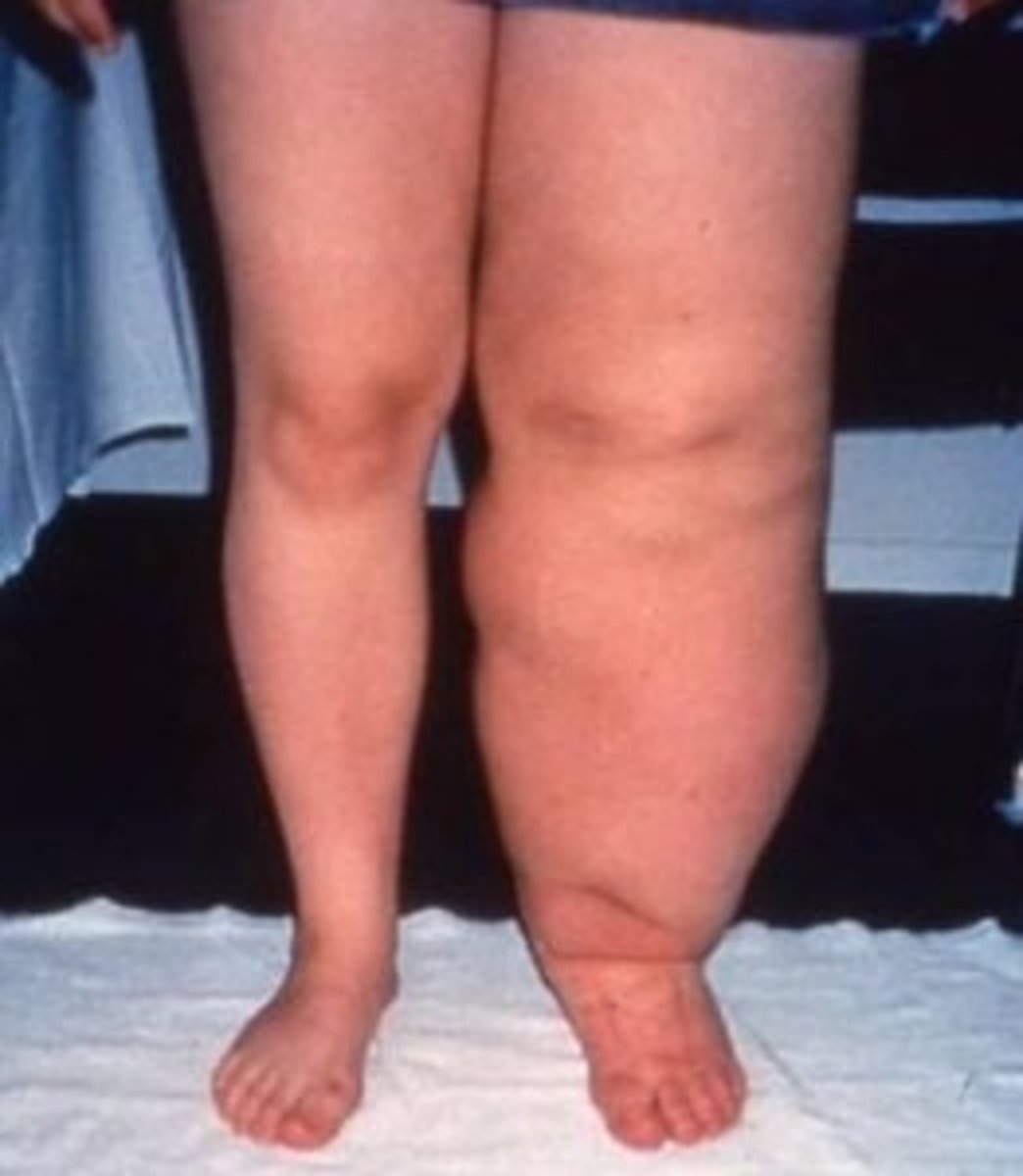<p>Linfedema</p>