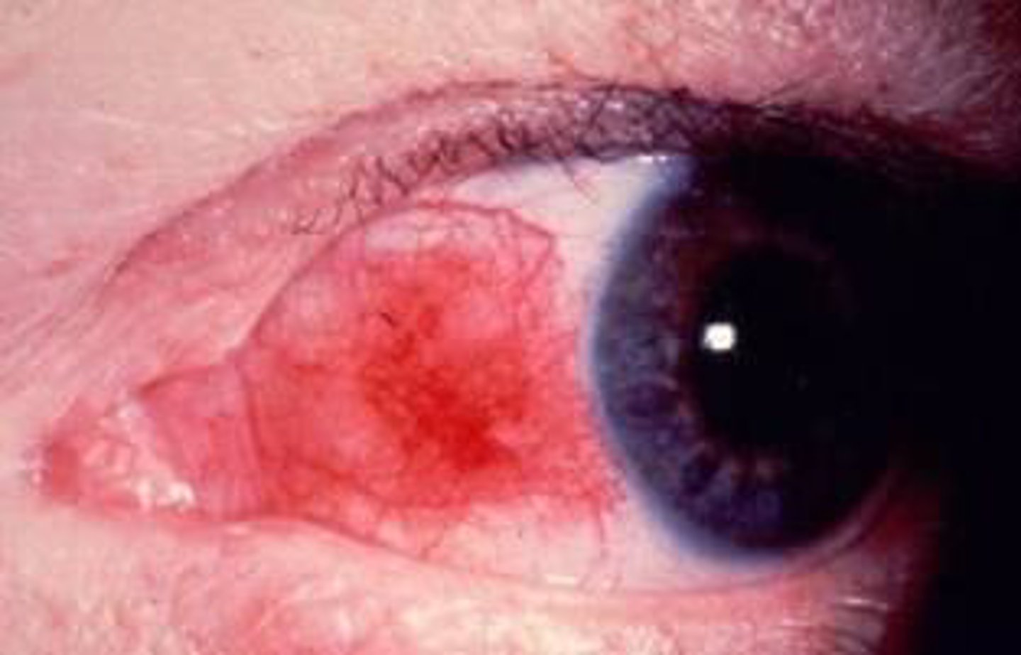<p>most cases are idiopathic; inflammation of the superficial layers of the sclera anterior to the insertion of the lateral rectus</p><p>Types:</p><p>Simple = intermittent episodes of moderate-to-severe inflammation often recurring at 1 to 3 month intervals</p><p>Nodular = prolonged attacks of inflammation, typically more painful</p>