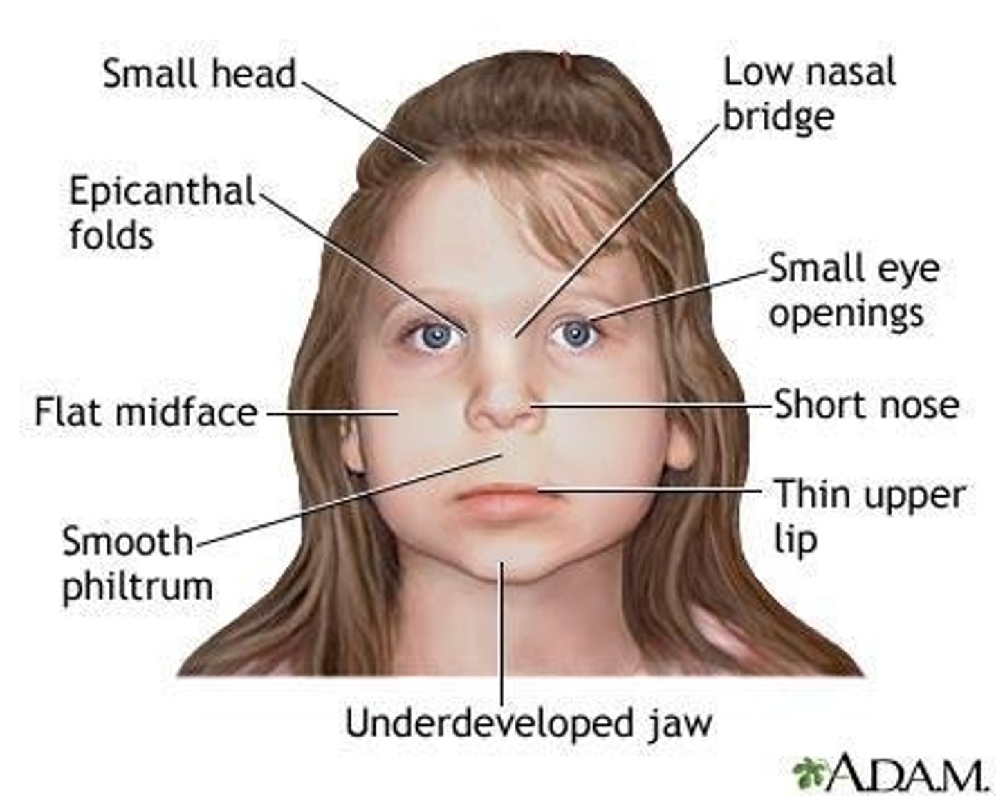 <p>True or false? FASD does not always include characteristic facial features</p>