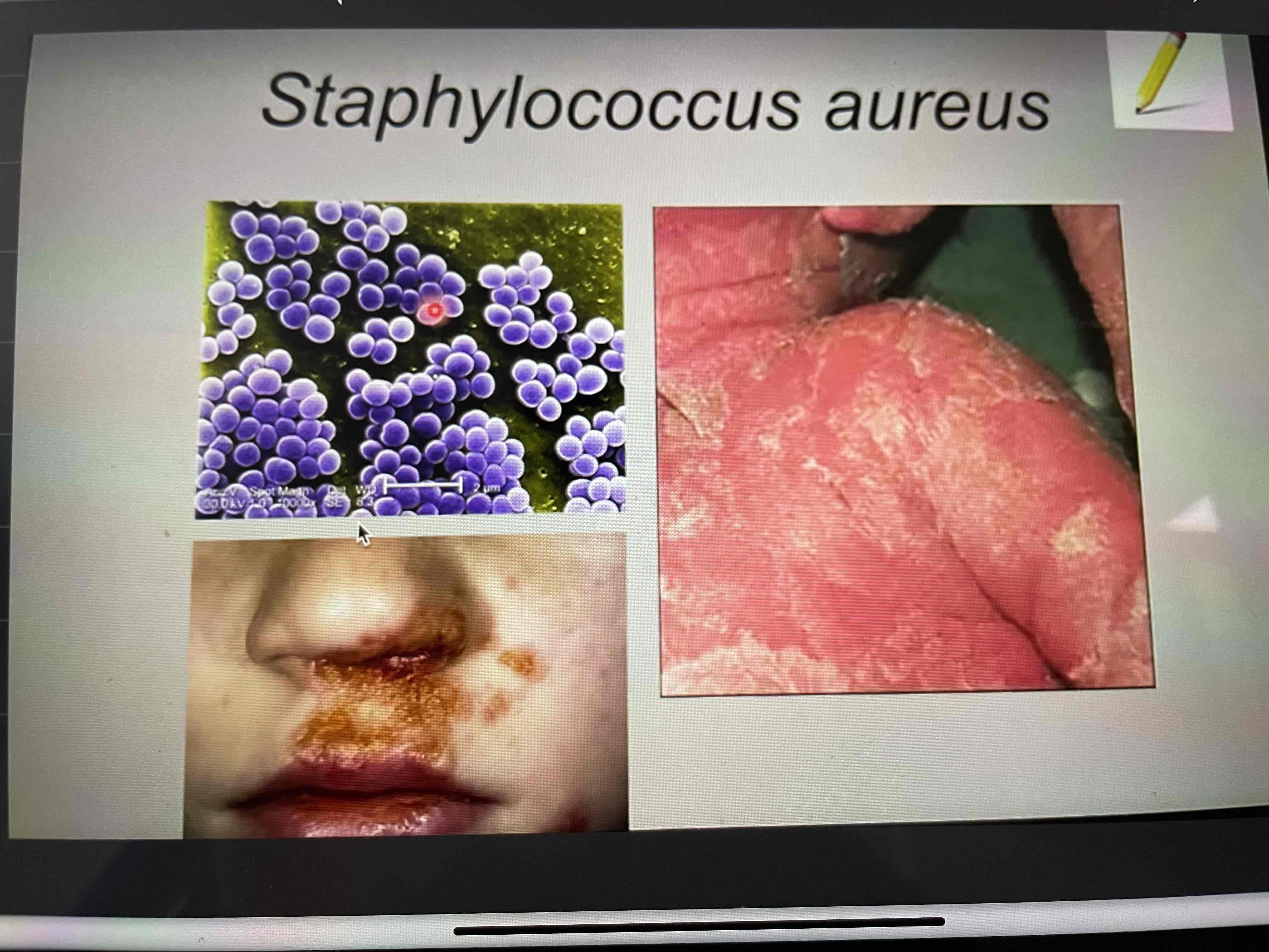 <p><strong>Type: </strong>bacteria, Gram (+) cocci</p><p><strong>Disease:</strong> skin infections with pus, boils, impetigo</p><p><strong>Pathogenesis:</strong> (opportunistic pathogen)</p><ul><li><p>Break in skin allows for infection</p></li><li><p><u>Production of toxins that</u>:</p><ul><li><p>Inhibit phagocytosis (cell eating; WBC eat bacteria)</p></li><li><p>Cause pus formation</p></li><li><p>Separate dermis from epidermis (exfoliative toxin) → <em>sloughing skin</em></p></li></ul></li></ul><p><strong>Treatment:</strong> Non-penicillin antibiotic if (MRSA), vancomycin</p><p></p>