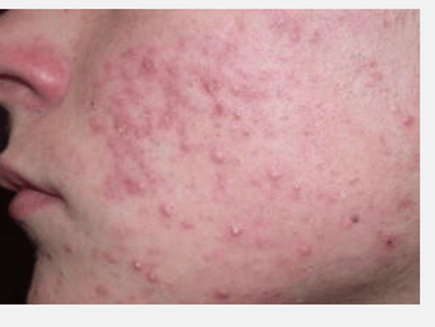 <p>Acne Vulgaris (AV)</p>