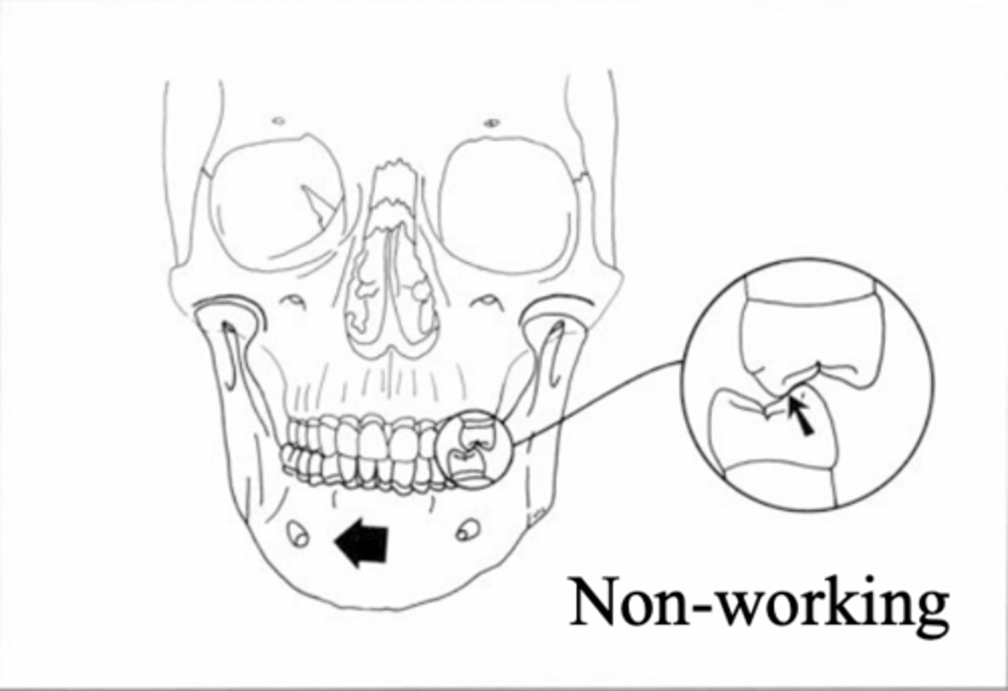 <p>Side that the mandible moves away from during a lateral excursion, non-working condyle</p>