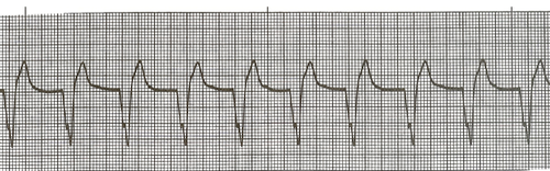 Accelerated Idioventricular Rhythm