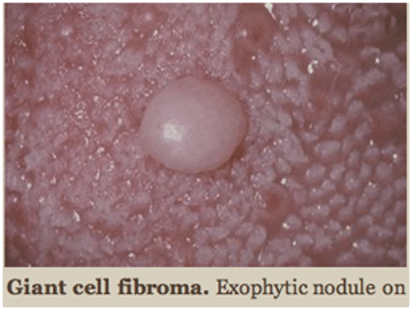 <p>___ ___ fibroma are fibrous tumors that unlike traumatic fibroma, it does not appear to be associated with chronic irritation. It often presents clinically as asymptomatic, with a papillary surface, common in young patients, 50% of all cases occur on gingiva but tongue and palate are also common sites. Its treated with conservative surgical excision with submission of tissue for histopathologic examination and recurrence is rare</p>