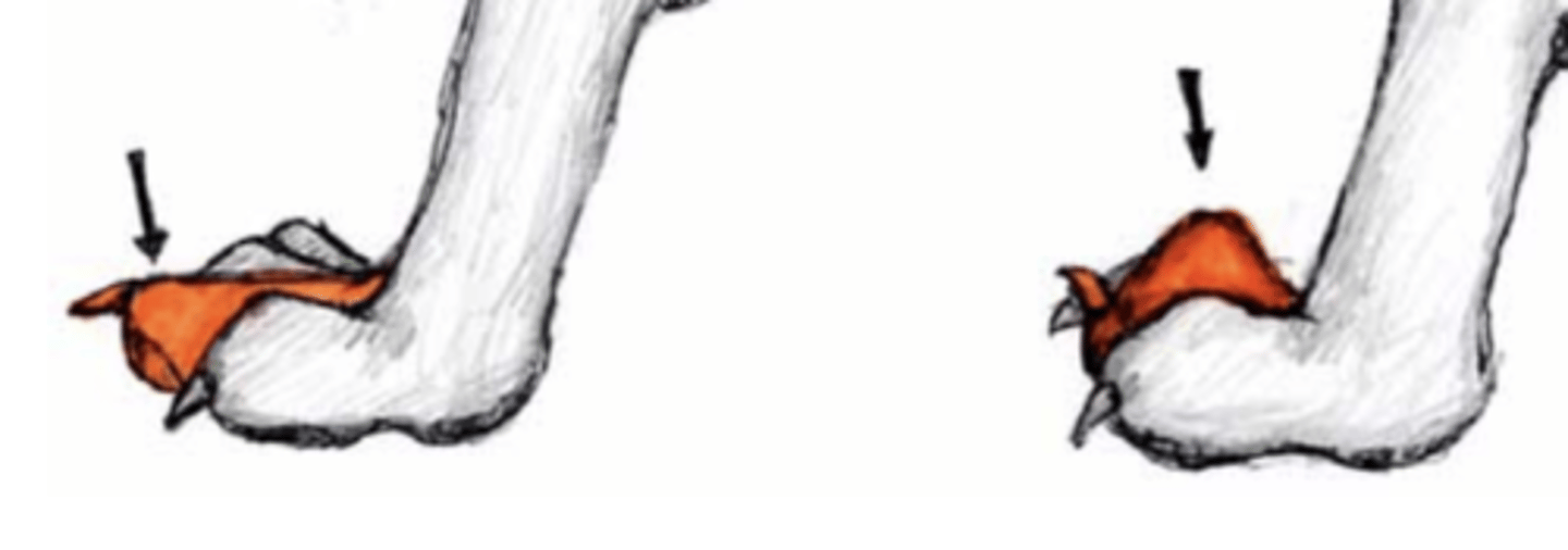 <p>A "Dropped toe" is caused by a torn ____________ while a "knocked up toe" is caused by a torn _____________.</p>