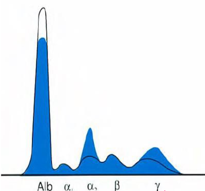 <p>Decreased Albumin, increased alpha 2 (α2), increased Gamma</p>