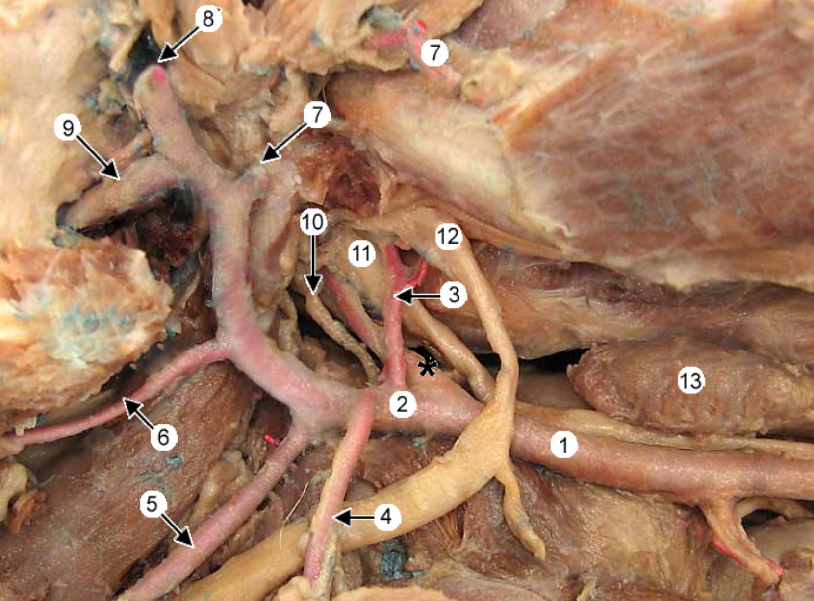 <p>this is an up close image of the common carotid artery (1), the head is to the left</p><p>2 is the external carotid artery &amp; * is the internal.</p><p>label all arteries except 4, 10, 11</p><p>label the other structures 12, 13</p><p></p><p>13 → SPELLING</p>