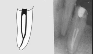 <p><span><span>(2-1)</span></span></p><p><span>Two separate canals leaving the pulp chamber but merging short of the apex to form only one canal</span></p>