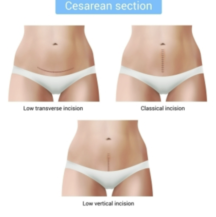 <ul><li><p>Skin incision:</p><ul><li><p>Vertical </p></li><li><p>Transverse</p></li></ul></li><li><p>Uterine incision types:</p><ul><li><p>Vertical- low or classical</p></li><li><p>Transverse&nbsp;</p></li></ul></li></ul><p></p>