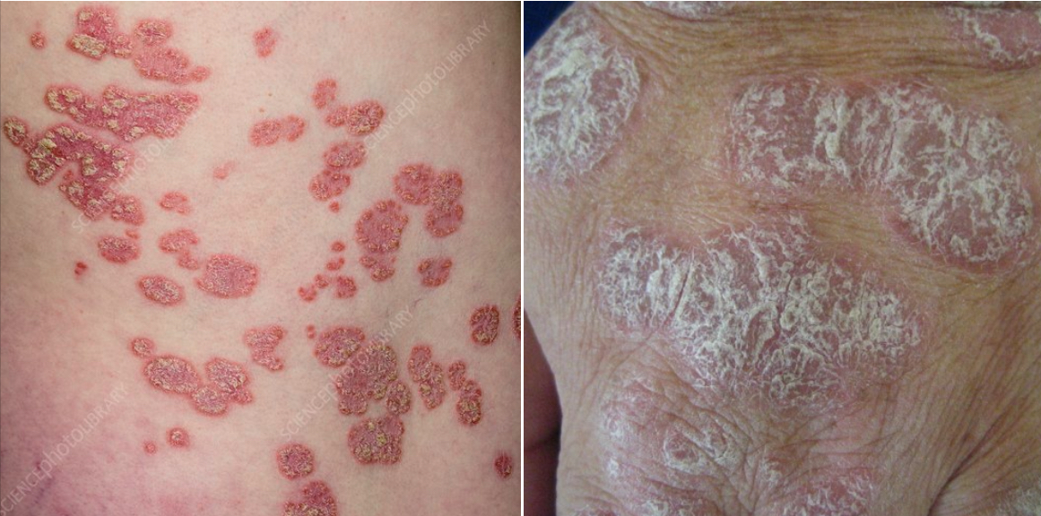 <p>Papules coalesce to form surface elevation. A plateau-like, disk-shaped lesion. Ex: psoriasis, lichen planus </p>