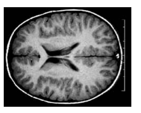 <p>looking down at the brain from above</p>