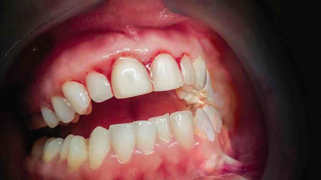 <p>Inflammation of the gums</p>