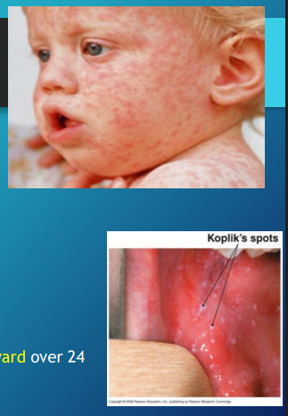 <p><strong>Measles: Background</strong></p><p>-Etiology → ________________</p><p>-Phases </p><ul><li><p>(1) Incubation → __-___ days from exposure to onset of symptoms </p></li><li><p>(2) Prodromal → cough, coryza, _____________, ______ spots </p></li><li><p>(3) Exanthematous → high _____ (104-105), macular ____ beginning on head/_________ and progresses _________ over 24 hours </p></li><li><p>(4) Recovery </p></li></ul><p>-Koplik spots → small, bluish white lesions with a red halo that appear inside the mouth, typically on the inner lining of the cheeks opposite the molars </p><p></p>