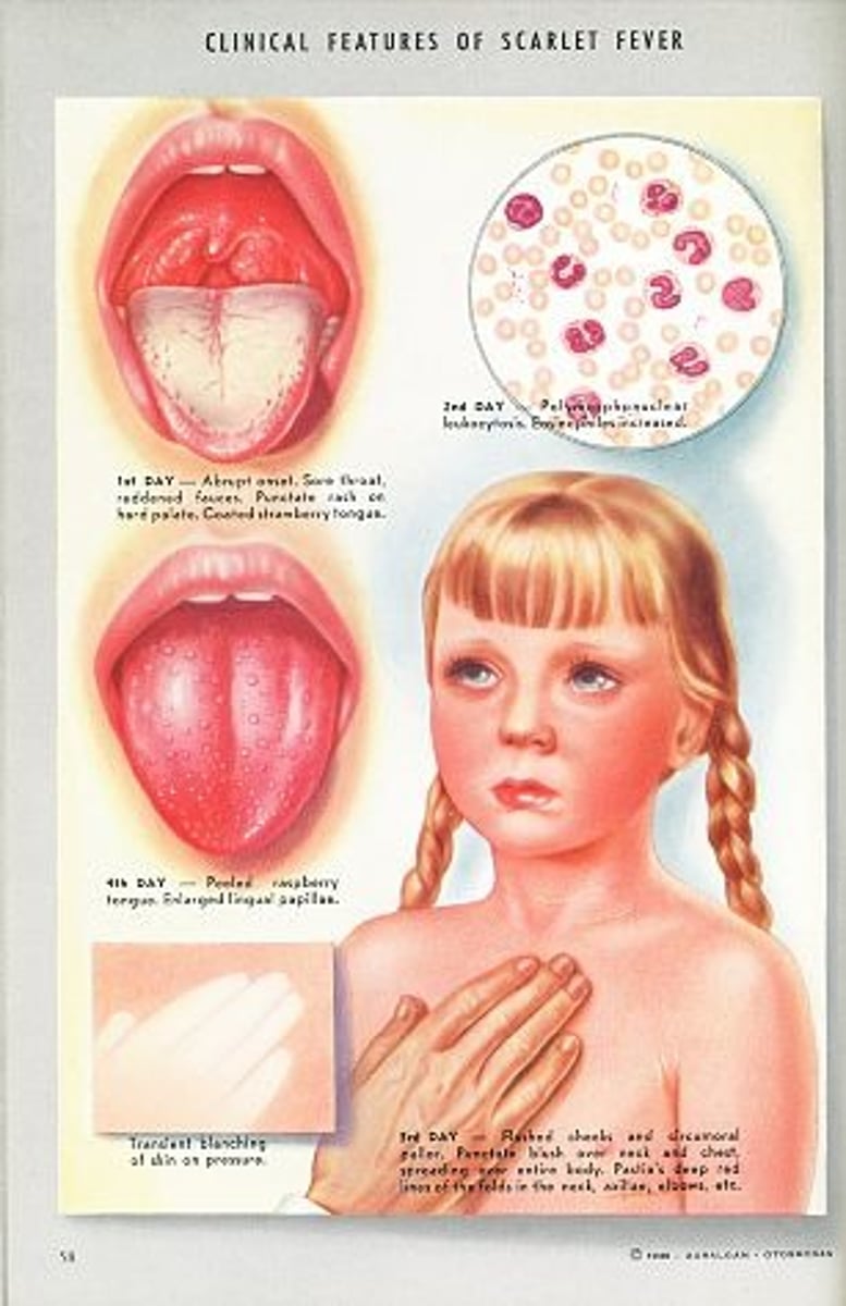 <p>CA: Streptococcus Pyogenes<br>MOT: -resp. droplets<br>Si/Sx: -F/N -red, sore throat -dysphagia -englarged neck glands -abd. pain <br>Dx: -Strep A testing<br>Tx: -ABX (penicillins) -analgesic (tylenol)</p>