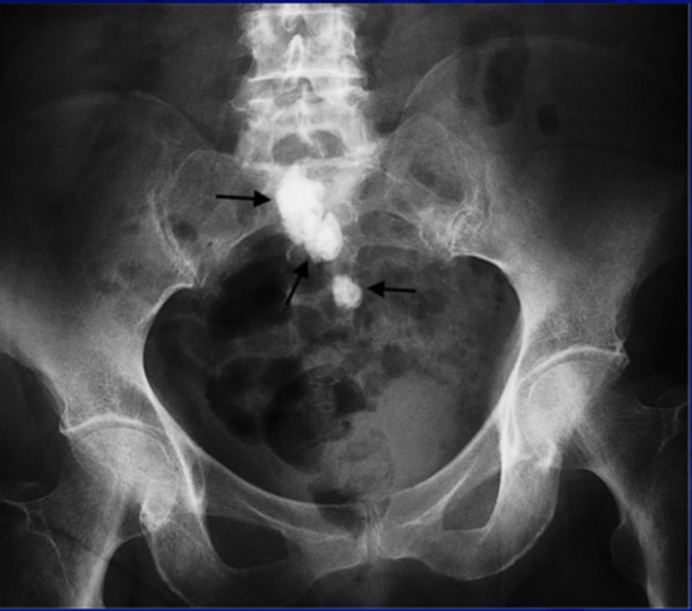 <p>Tuberculosis</p>