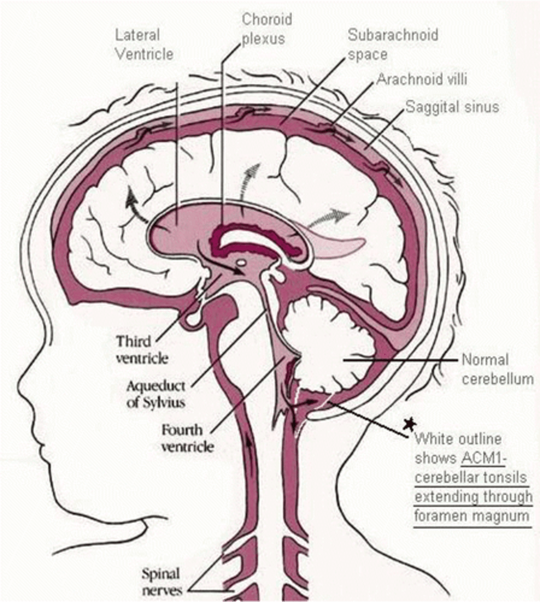 <p>medulla &amp; cerebellum extend through foramen magnum</p>