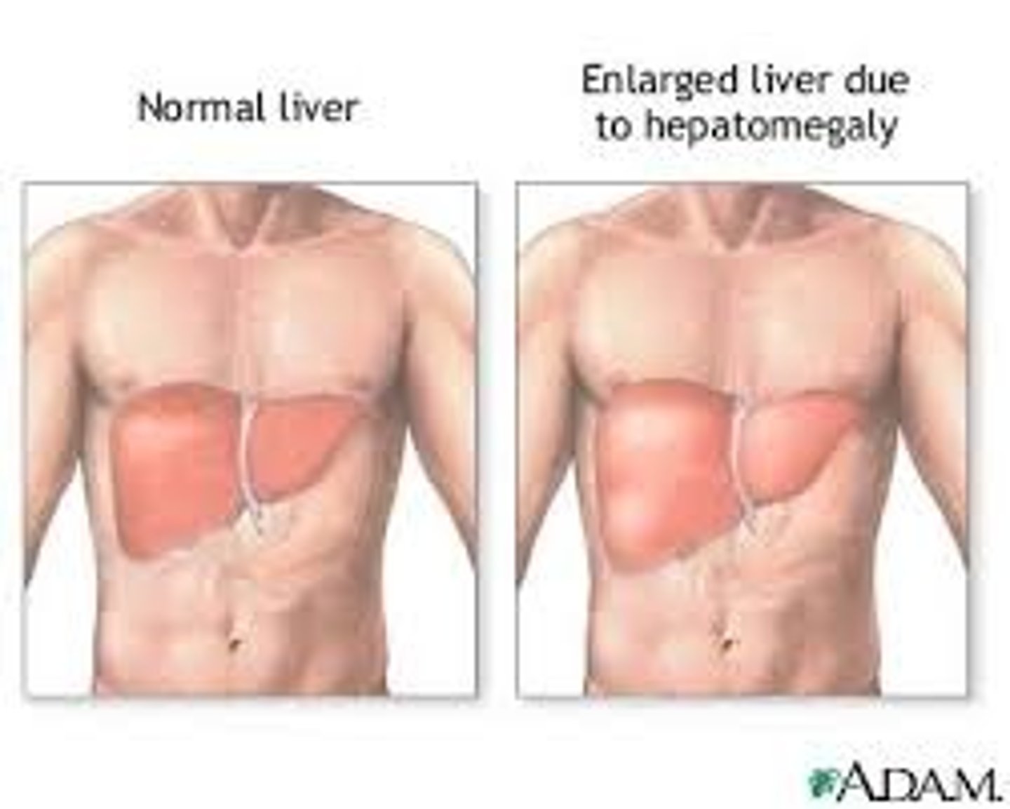 <p>Enlarged liver. (Seen on CT abdomen)</p>