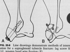 <ul><li><p><span style="background-color: transparent;"><strong><span>Body & Spine</span></strong></span></p><ul><li><p><span style="background-color: transparent;"><strong><span>Minimally displaced:</span></strong><span> stable, Velpeau sling 2-3w</span></span></p></li><li><p><span style="background-color: transparent;"><strong><span>Comminuted or Transverse: </span></strong><span>unstable, </span><u><span>internal fixation**</span></u></span></p><ul><li><p>can fold on itself</p></li></ul></li></ul></li><li><p><span style="background-color: transparent;"><strong><span>Supraglenoid Tuberosity</span></strong></span></p><ul><li><p><span style="background-color: transparent;"><strong><span>Et: </span></strong><u><span>immature dogs</span></u><span>, </span></span><span style="background-color: transparent; color: red;"><span>avulsion/physeal separation</span></span><span style="background-color: transparent;"><span> from biceps pull</span></span></p></li><li><p><span style="background-color: transparent;"><strong><span>Tx: </span></strong><span>pin + tension band, or lag screw</span></span></p></li></ul></li><li><p><span style="background-color: transparent;"><strong><span>Neck & Glenoid Cavity</span></strong></span></p><ul><li><p><span style="background-color: transparent;"><strong><span>Tx: </span></strong><span>reconstruction required,</span><u><span> cross pins, lag screw</span></u></span></p></li></ul></li></ul><p></p>