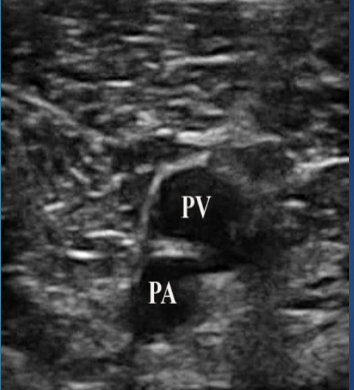 <p>What is site 6 for DVT?</p>