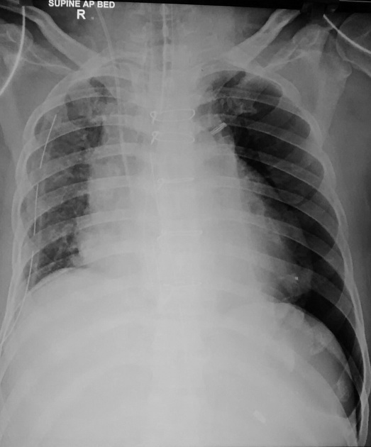 <p>Describe the abnormality demonstrated.</p>